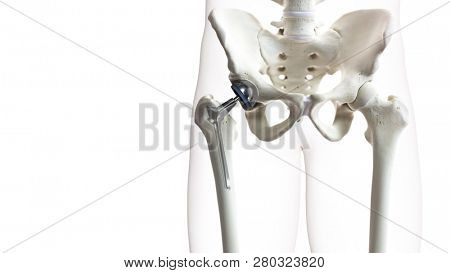 3d rendered medically accurate illustration of a hip replacement