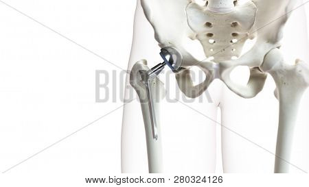3d rendered medically accurate illustration of a hip replacement