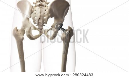 3d rendered medically accurate illustration of a hip replacement