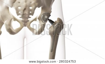 3d rendered medically accurate illustration of a hip replacement