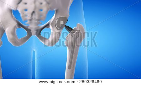 3d rendered medically accurate illustration of a hip replacement