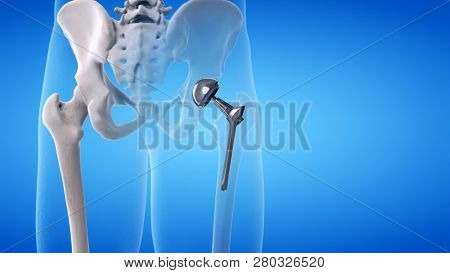 3d rendered medically accurate illustration of a hip replacement