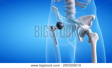 3d rendered medically accurate illustration of a hip replacement