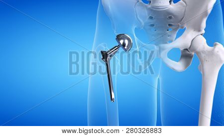 3d rendered medically accurate illustration of a hip replacement