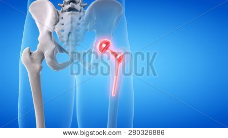 3d rendered medically accurate illustration of a painful hip replacement