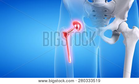 3d rendered medically accurate illustration of a painful hip replacement