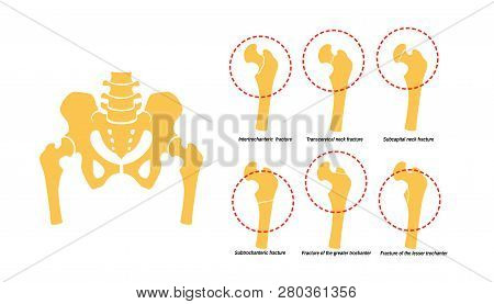 6 Types Of Femoral Neck Fracture. Fragment Of The Structure Of The Human Skeleton. Pelvic Girdle And