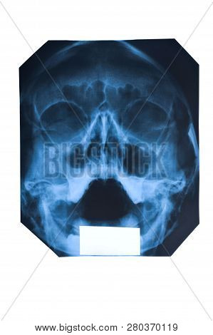 X-ray Of Face And Maxillary Sinuses Isolated On White