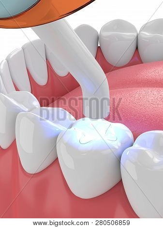 3d Render Of Jaw With Dental Polymerization Lamp And Light Cured Inlay Filling Over White Background