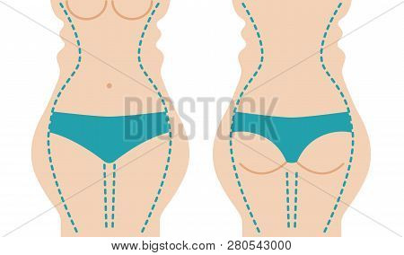 Liposuction Of Body. Slim Hips, Thin Waist. Weight Loss. Plastic Surgery Beautiful Female Figure. Ve