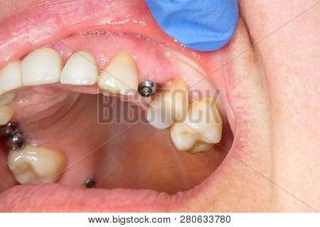 Close-up Dental Implant Wort Patient In A Dental Clinic During Treatment. The Concept Of Surgical Ae