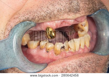 Rotten Teeth, Caries And Plaque Close-up In An Asocially Ill Patient. The Concept Of Poor Hygiene An