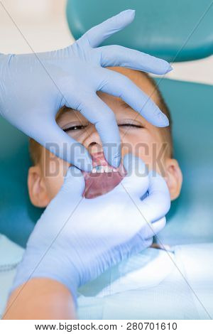 Little Boy Is Looking At His Teeth At Dentist. Close-up Of Dentists Hand Examining Teeth Of Child Pa