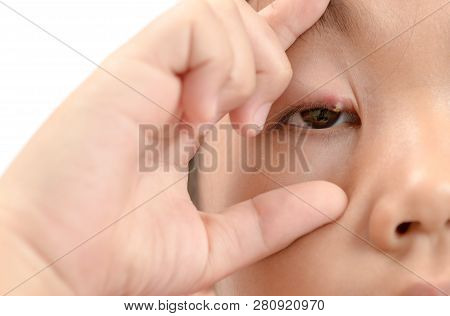 Close Up Of Asian Little Girl One Eye Infection Isolated On White Background, Eyelid Abscess, Stye, 