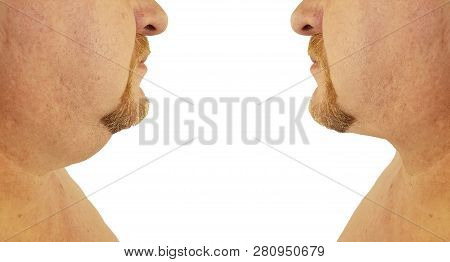 Submental Fat Man Before And After, Procedures