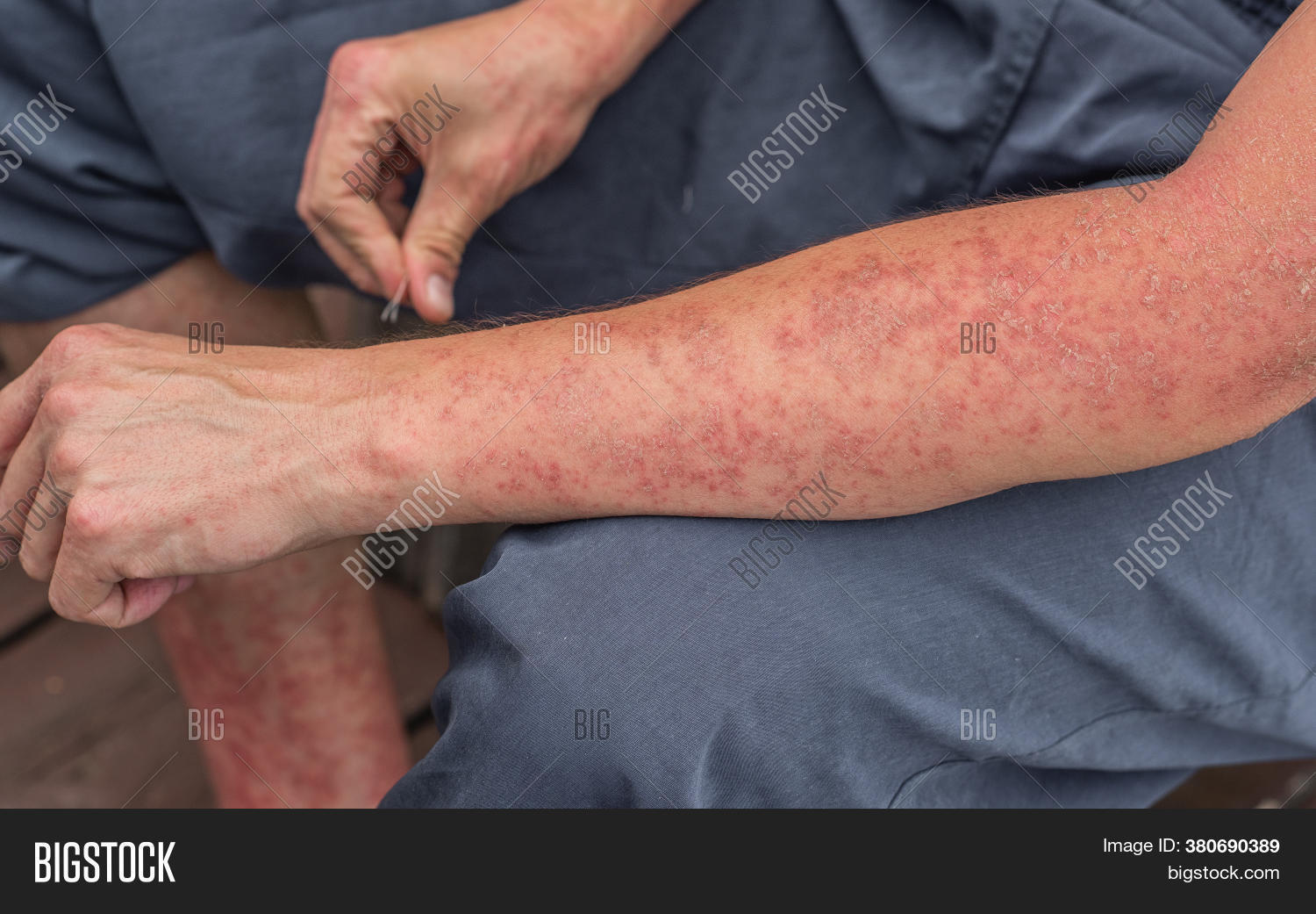 Dyshidrotic Autoimmune Image & Photo (Free Trial) Bigstock