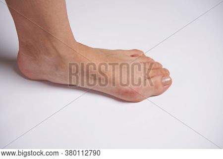 Hllux Valgus On Female Legs Close Up Isolated On White Background. Foot Joint Deformity. Health Care