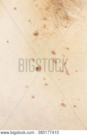 Papilloma Virus In The Armpit Of A Man, A Dermatological Problem, The Concept Of Skin Disease..