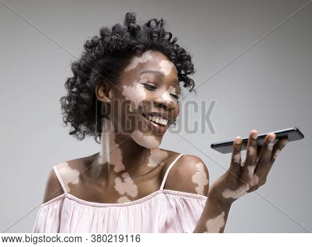 Portrait Of African-american Woman With Vitiligo Skin. Special Skin With Depigmentation Because Of M