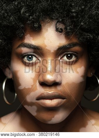 Portrait Of African-american Woman With Vitiligo Skin. Special Skin With Depigmentation Because Of M