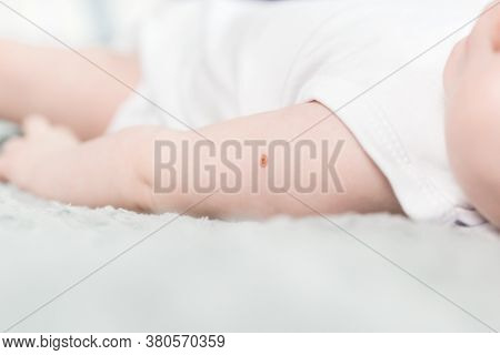 Hand Of A Newborn With Traces Of Bcg Vaccination - A Vaccine Against Tuberculosis Prepared From A St