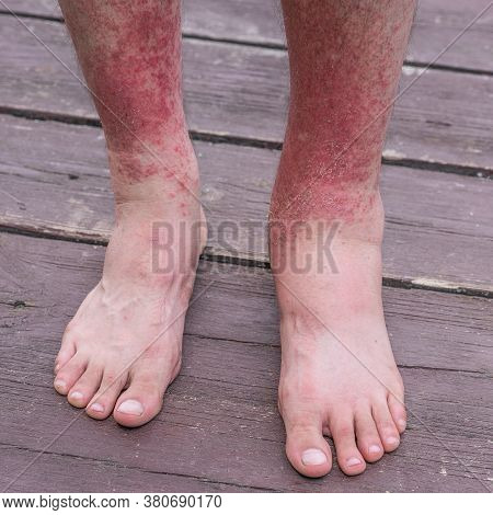 Dyshidrotic Autoimmune Eczema Of Patient. Concept Of Health Care