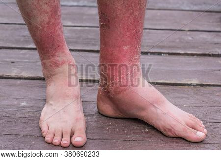 Dyshidrotic Autoimmune Eczema Of Patient. Concept Of Health Care