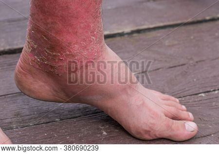 Dyshidrotic Autoimmune Eczema Of Patient. Concept Of Health Care