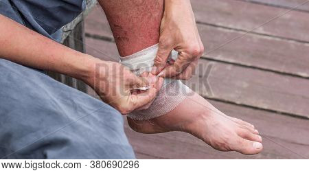 Dyshidrotic Autoimmune Eczema Of Patient. Concept Of Health Care