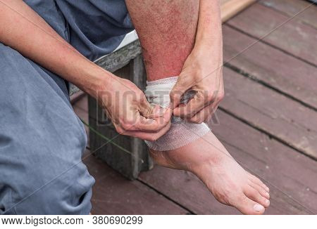 Dyshidrotic Autoimmune Eczema Of Patient. Concept Of Health Care