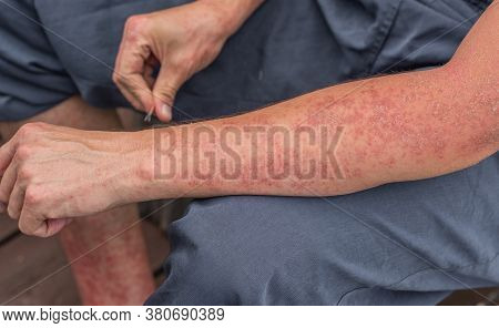 Dyshidrotic Autoimmune Eczema Of Patient. Concept Of Health Care