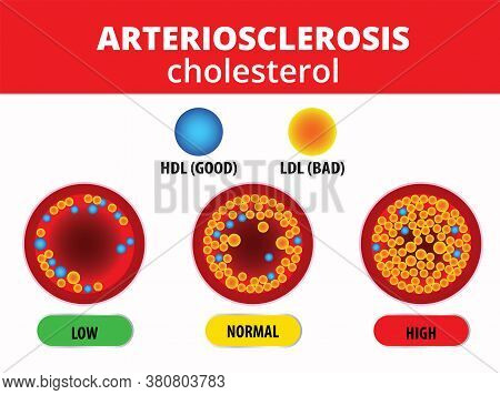 Cholesterol In Artery, Health Risk , Vector Design