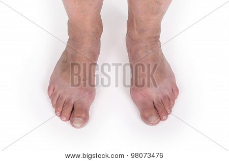 Old Woman With Varicose Veins