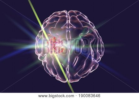 Destruction of brain tumor by laser, 3D illustration. Conceptual image for brain cancer treatment