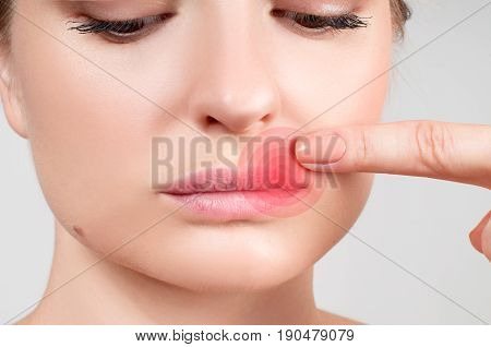 Close Up Of Female Lips Affected By Herpes Virus