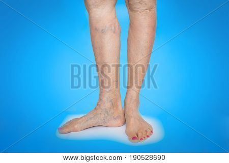The varicose veins on a legs of old woman on blue
