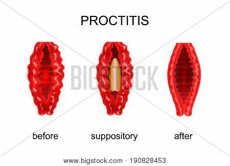 vector illustration of proctitis. before and after treatment of rectal suppositories