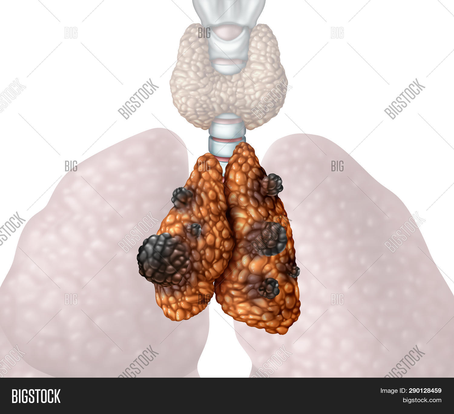 Thymus Cancer Thymoma Image & Photo (Free Trial) Bigstock