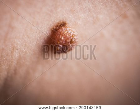 Unrecognizable Person Having Dark Fibroma, Dermatology Problem On Skin. Close Up Of Papilloma Dermat