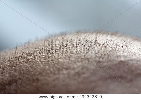 Short Hair On A Head Close Up. Scalp Man's Head. Baldness. Bald Man. Problems With Hair Growth On Th