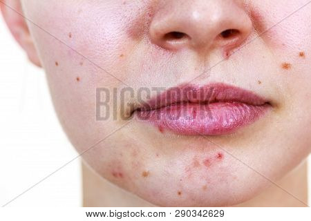 Young Woman Showing Her Face With Acne And Moles, Dry Lips. Teen Girl No Make Up With Red Spots On H