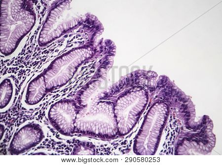 Histopathology Of Chronic Superficial Gastritis, Light Micrograph, Photo Under Microscope