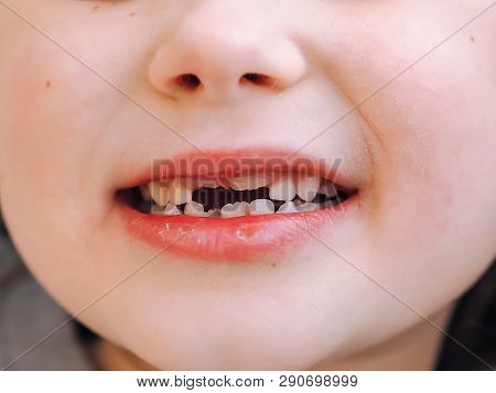 The Child Has A Milk Tooth And A New Adult Curve Tooth. Treatment And Care Milk Teeth In Children.
