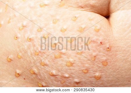 Plasmolifting. Injections For Rejuvenation And Skin Regurgitation From Human Plasma. A Modern Beauty
