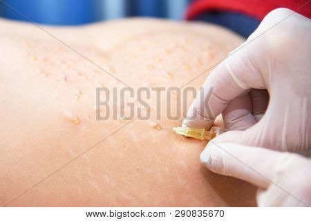 Plasmolifting. Injections For Rejuvenation And Skin Regurgitation From Human Plasma. A Modern Beauty