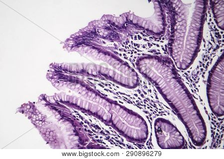 Histopathology Of Chronic Superficial Gastritis, Light Micrograph, Photo Under Microscope