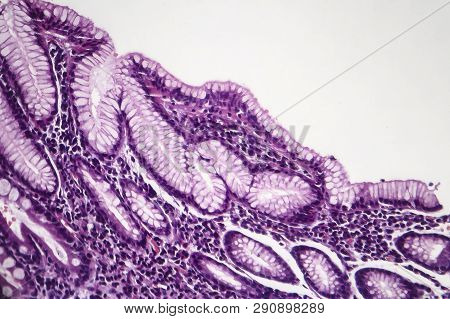 Histopathology Of Chronic Superficial Gastritis, Light Micrograph, Photo Under Microscope