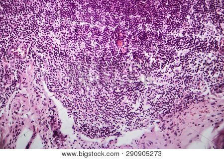 Acute Simple Appendicitis, Light Micrograph, Photo Under Microscope