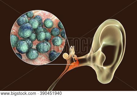 Otitis Media Caused By Bacteria Staphylococcus Aureus, An Inflammatory Disease Of The Middle Ear, 3d