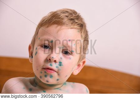 Young Toddler,boy With Chickenpox. Sick Child With Chickenpox. Varicella Virus Or Chickenpox Bubble